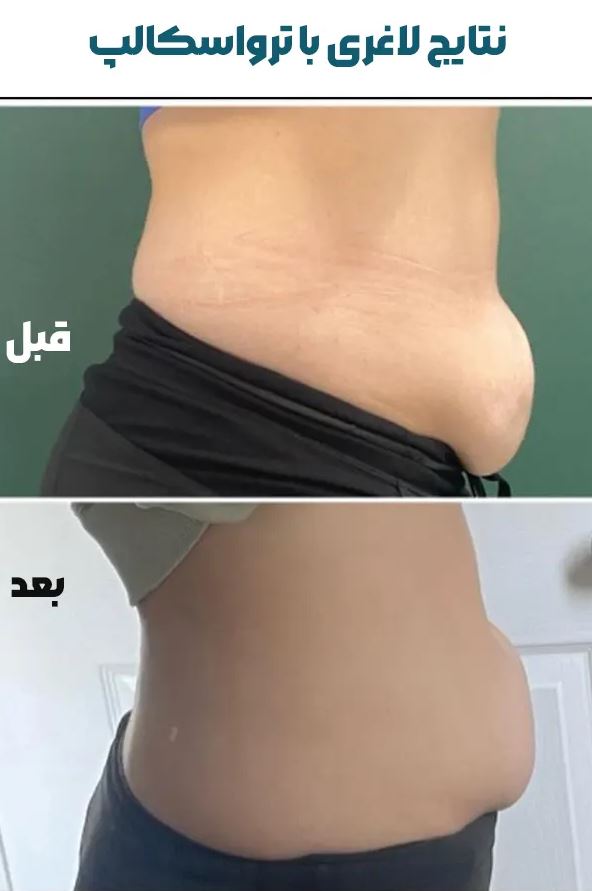 لاغری و فرم‌دهی بدن با ترو اسکالپ