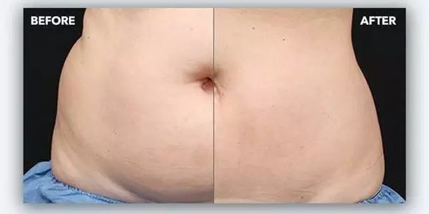 کاهش چربی بدون جراحی با کول اسکالپتینگ