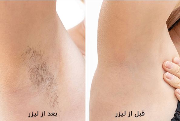 آیا لیزر موهای نازک را ضخیم می کند؟