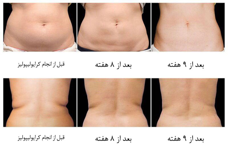 بررسی انواع دستگاه های لاغری موضعی