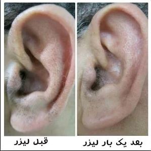 موهای گوش و بینی