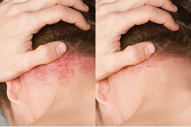 پسوریازیس و لیزر مو: بایدها و نبایدها