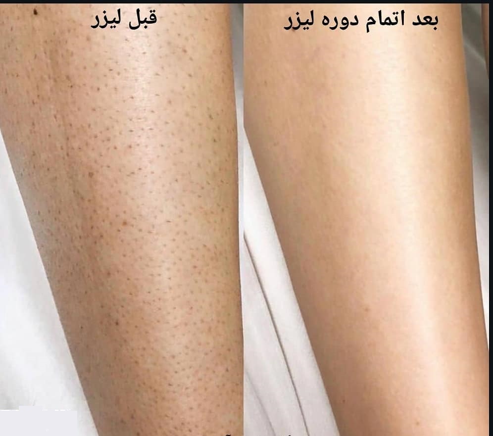 تحلیل انواع پوست