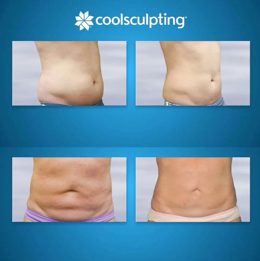 کاهش چربی بدون جراحی با کول اسکالپتینگ